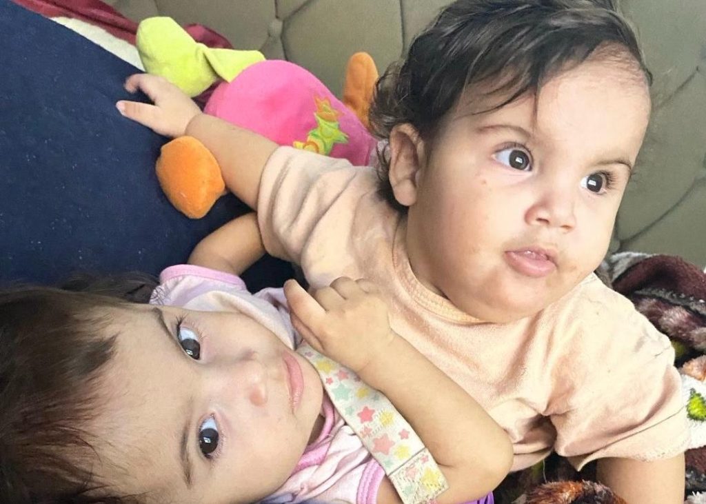 Irmã de siamesa que morreu após cirurgia continua internada em estado grave irma-de-siamesa-que-morreu-apos-cirurgia-continua-internada-em-estado-grave